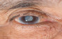 أسباب وأعراض الماء الأزرق في العين (الزّرق)